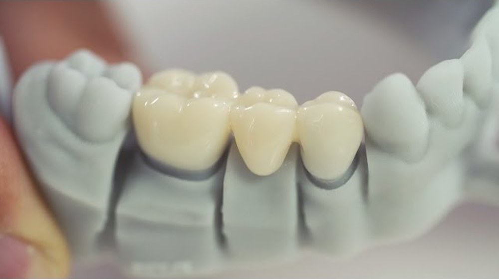 3D-printed temporary dental crowns on a model